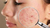ANSM: Nguy cơ tiềm ẩn nghiêm trọng khi lạm dụng isotretinoin cho mục đích thẩm mỹ